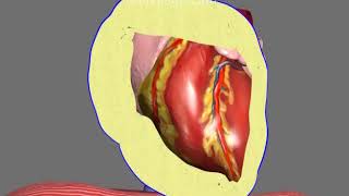 Pericardiocentesis in Pericardial Effusion and Cardiac Tamponade Animation by Cal Shipley MD [upl. by Yelik824]