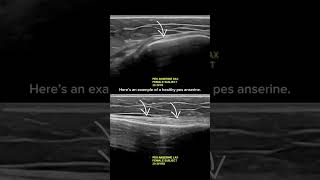 ultrasound Guided Interventions Healthy Images Pes Anserine [upl. by Magen294]