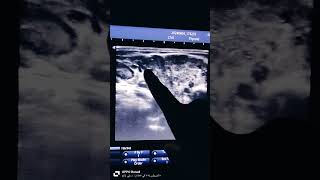 parotid ultrasound viral parotitis and sjogren syndrome VS normal parorid [upl. by Leemaj]