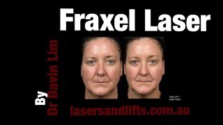 How long does it take to recover from Fraxel laser [upl. by Etakyram]