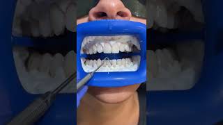 InOffice Teeth Whitening Process 🫶🏻 [upl. by Aenyl]