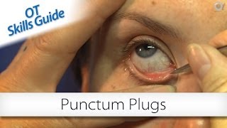 OT skills guide punctum plugs [upl. by Ardnas]