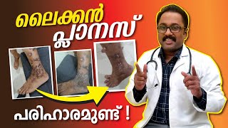 ലൈക്കെൻ പ്ലാനസ്‌നു ഒരു പരിഹാരമാർഗ്ഗം 👍🏼 Lichen planus treatment malayalam DrSuneefHaneefa [upl. by Laris471]