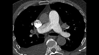 Patent ductus arteriosus may mimics Pulmonary Embolism  CTPA [upl. by Idnal]