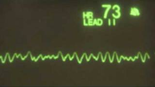 Ventricular Fibrillation  ECG Training Tutorial [upl. by Yared901]