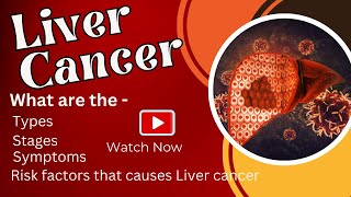 Liver Cancer  What are the types  Stages  Symptoms  Risk factors that causes Liver cancer [upl. by Goodden616]