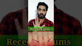 नीचे जा रहे मसूड़ो का घरेलू इलाज  Gum recession home remedies  easy dentistry shorts [upl. by Helbonia]