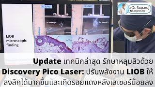 เทคนิคล่าสุดรักษาหลุมสิวด้วยเทคนิคโปรแกรมDiscovery Pico LaserการปรับพลังงานLIOBให้ลงลึกได้มากขึ้น [upl. by Akcimahs]