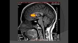 Colloid Cyst Neuroepithelial Cyst [upl. by Rebmac964]