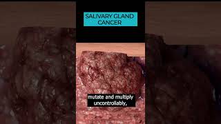 Salivary Gland Cancer Uncovering Head and Neck Cancer Types 🎗️🩺 [upl. by Watt]