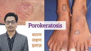 Porokeratosis का कारण लक्षण और इलाज़  Porokeratosis और cancer porokeratosis skincancer cancer [upl. by Adnic]