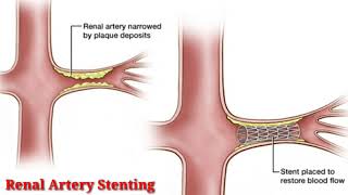 Renal Artery Stenting  live Renal Angioplasty surgery in Hyderabad by Dr Shaileshkumar Garge [upl. by Ahsropal796]