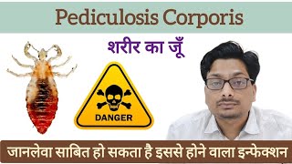 शरीर का जूँ  Body Lice  जानलेवा साबित हो सकता है इससे होने वाला इन्फेक्शन  Pediculosis Corporis [upl. by Redman]