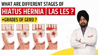 Grades of GERD  Stages of Hiatus Hernia  Hindi [upl. by Scevour138]