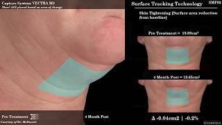 SculpSure for Submental Fat Reduction Under the Chin Fat [upl. by Euqinommod]