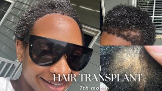 7 MONTH HAIR TRANSPLANT REVIEW TURKEY LONGEVITA [upl. by Ecinehs559]