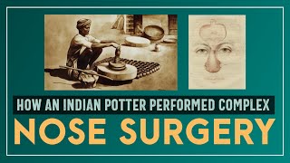 Worlds First Nose Surgery And Its Link to Ayurveda  in Hindi [upl. by Kciwdahc635]