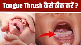 How To Treat Baby Thrush In Mouth How To Apply Thrush Medicine To Mouth Boldsky [upl. by Aicinoid]