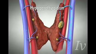 Hyperparathyroid PTH [upl. by Camila]