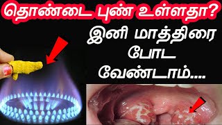 என் பாட்டி கை வைத்தியத்தால் எனக்கு சரியானது  thondai pun maruthuvam  Throat Pain  thondai vali [upl. by Nywles]