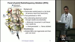 Radiofrequency Ablation RFA for Lumbar Facet Arthropathy Hisashi Wesley Kobayashi MD [upl. by Olmstead]