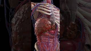 Cirrhosis Liver Under Siege 3dmodel meded anatomy [upl. by Karlik716]