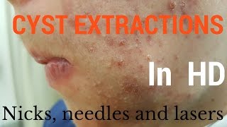 Cysts extractions blackheads  Removal methods in HD [upl. by Eiger239]