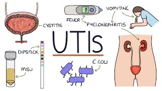 Understanding Urinary Tract Infections [upl. by Yup]