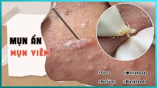 Big Cystic Acne Blackheads Extraction Blackheads amp Milia Whiteheads Removal Pimple Popping [upl. by Annawal592]