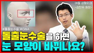 EFIL성형외과 QnA 돌출눈 Exophthalmos [upl. by Eatnhoj]