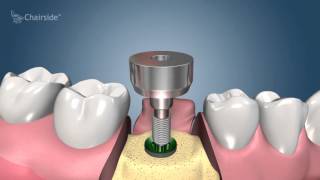 Dental Implant Procedure  Two Stage 🦷 Award Winning Patient Education [upl. by Yerrot]