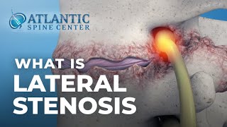 What Is Lumbar Lateral Stenosis  Foraminal Stenosis [upl. by Arriaet]