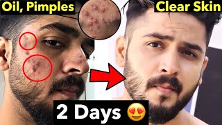 10 Pimple Mistakes  How to Remove Pimples From Face  Remove Acne Naturally [upl. by Juley199]