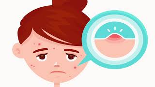 Acne and its treatments [upl. by Aned405]