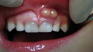 दांतों में पस  INFECTION DENTAL ABSCESS  ITS TYPES CAUSES AND TREATMENT DR Rajni Bala HINDI [upl. by Yemaj]