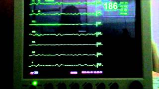 ELECTROCARDIOGRAFIA  ANORMALIDADES DEL ECG [upl. by Refotsirk62]