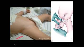 How to Place a Femoral CVL in an Infant [upl. by Biron718]