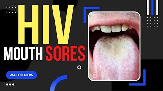 When Do Hiv Mouth Sores Appear [upl. by Carlee588]