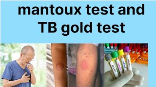 Mantoux test hindi main TB gold test hindi mainTB disease investigation [upl. by Catharine163]