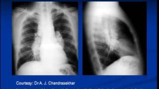 Chest xray interpretation Sarcoidosis [upl. by Grogan902]