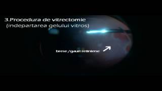 Operatie de vitrectomie pe un ochi cu dezlipire de retina regmatogena [upl. by Nylahs357]