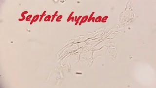 Septate hyphae Skin Fungal KOH preparation [upl. by Zwiebel]