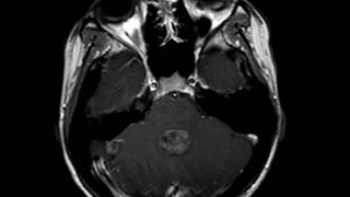 Ependymoma [upl. by Nesnar]