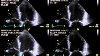 TRUE SEVERE AORTIC STENOSIS  STRESS ECHOCARDIOGRAPHY cardiac ultrasound [upl. by Leiba903]