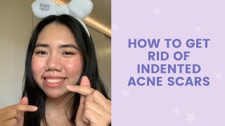 How To Get Rid of Indented Scars  FaceTory [upl. by Fauver]