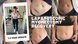 Laparoscopic Myomectomy Recovery 15 Year Update [upl. by Irok]