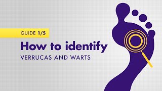 How to identify verrucas and warts [upl. by Hecker]