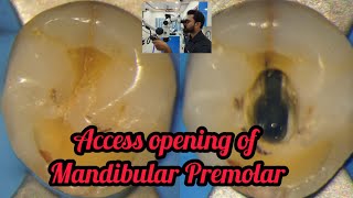 Access opening of Mandibular Premolar step by step demonstration rct for beginners dental lectures [upl. by Smoht]