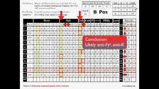 Antibody ID Basic Cases Part 2 [upl. by Larkins]