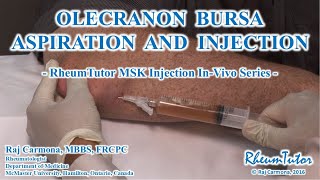 OLECRANON BURSA ASPIRATION  INJECTION  InVivo Series [upl. by Aniuqal]